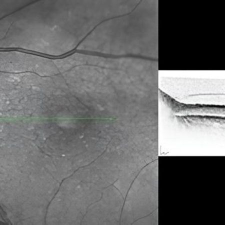 OCT Aufnahme eines Patienten mit Makuladegeneration