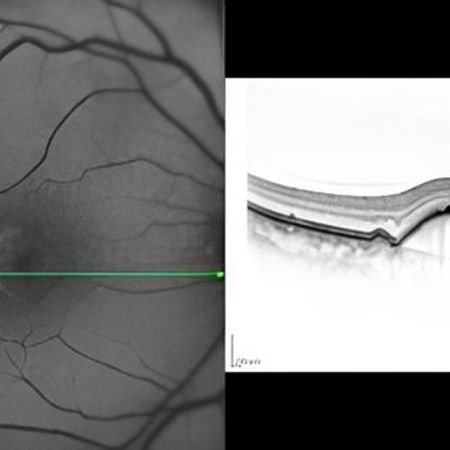 OCT Aufnahme eines Patienten mit Makuladegeneration