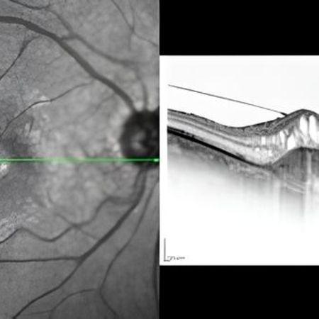 OCT Aufnahme eines Patienten mit Makuladegeneration